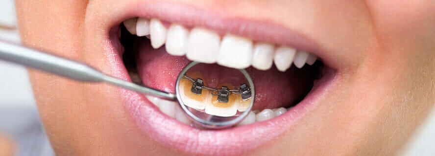 brackets-linguales-barcelona brackets-linguales-barcelona